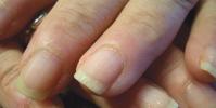 Почему ломаются ногти на руках и какие есть средства от ломкости ногтей?