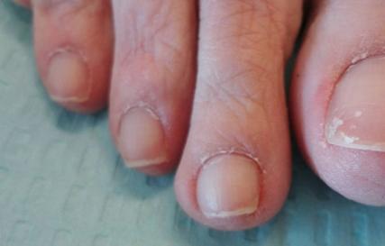 Why do fingernails and toenails peel and break?